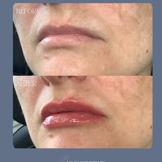 Fresh off the needle 💋

First-time lip filler using 0.6 mL of HA filler to add hydration, subtle vo