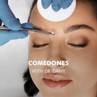 Acne is easy to treat yet so many struggle with inappropriate treatments. Comedones are often caused