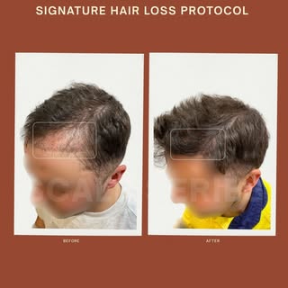At Scalp Series Melbourne, we specialise in advanced hair loss treatments and scalp health solutions