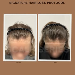At Scalp Series Melbourne, we specialise in advanced hair loss treatments and scalp health solutions