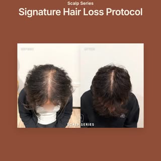 At Scalp Series Melbourne, we specialise in advanced hair loss treatments and scalp health support.
