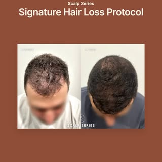 Scalp Series is a boutique Medical Hair Restoration clinic in Melbourne. We offer evidence-based tre