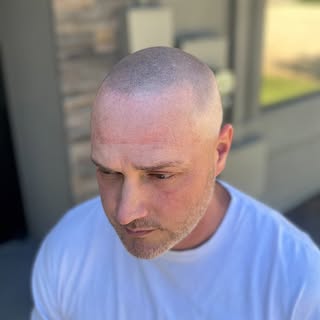 From bare to bold! Stunning scalp micropigmentation transformation. #SMP #NewLookNewConfidence