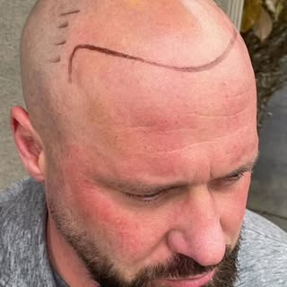 From thinning to winning: scalp micropigmentation reveals a bold, confident before-and-after! #Scalp