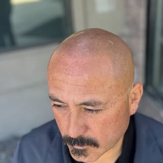 Transform your confidence with Scalp Micropigmentation! 💪 Before & After: fuller, natural-looking h