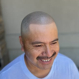 Before: Patchy mess, zero swagger. After: Clean, dense scalp post-fourth micropigmentation session! 