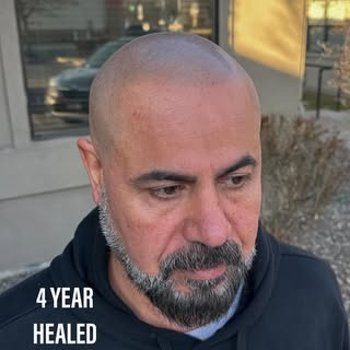 4 YEARS HEALED.

This is the difference that proper technique makes.
Scalp micropigmentation should 