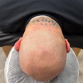 If you’re tired of seeing the horseshoe pattern in the mirror, this is exactly what Scalp Micropigme