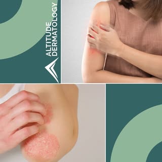 Your skin deserves the best care! At Altitude Dermatology, we offer a wide range of dermatological s