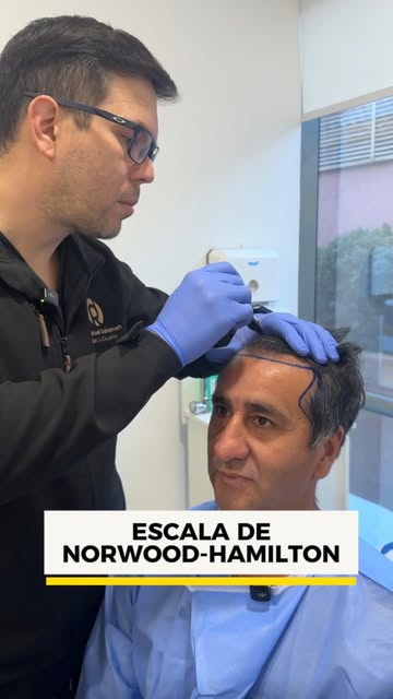 🚨Niveles de #alopecia el Doctor Rafael @dr.rafaelodreman nos enseña y explica ESCALA DE NORWOOD-HAM
