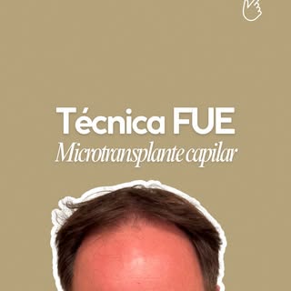 ✨Resultados reales que transforman confianza.

En Marinacci Grupo Médico realizamos transplante capi