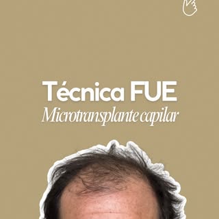 ¿Las entradas o la pérdida de cabello cambian tu imagen? Deslizá para conocer el antes y después 👉
