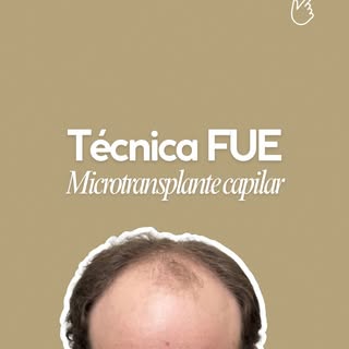 ¿Qué hace que un trasplante capilar se vea realmente natural?

No es solo implantar cabello. Es plan