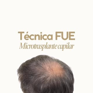 📍¿Sabías que la coronilla es una de las zonas más desafiantes en un microtrasplante capilar?

En es