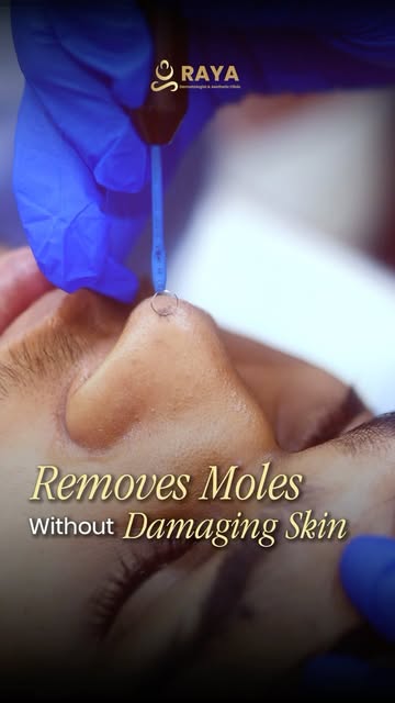 ✨ Mole bothering you? Let’s talk about safe & effective Mole Removal! ✨

Kya face ya body par koi mo