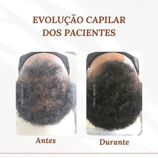 Evolução capilar parcial de um tratamento personalizado para Alopecia Androgenética (Calvície)

12 s