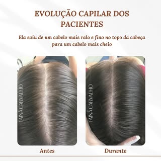 Cabelo crescendo mais fino e ficando ralo especialmente no topo da cabeça, com alargamento da “linha