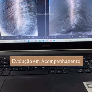 Evolução em acompanhamento de um quadro de calvície feminina associado a um período de queda excessi