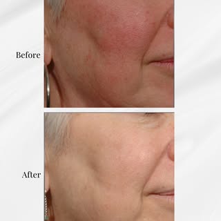 Struggling with redness or rosacea? IPL (Intense Pulsed Light) might be the solution. ✨ This non-inv