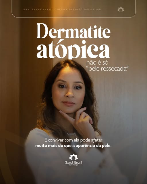 Eu sempre reforço aos meus pacientes que dermatite atópica vai muito além de uma pele ressecada. Coc