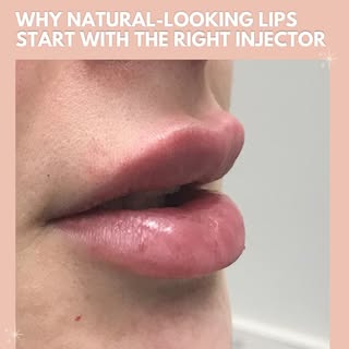 The person holding the syringe matters 💋

Our experienced injectors understand your facial features