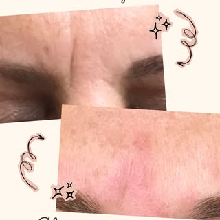 Those two vertical lines between your eyebrows? They're called 11 lines.

They form from years of fr