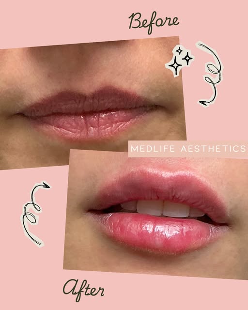 Look at those lips. 💋✨

A little more volume. A little more definition. A whole lot of confidence.
