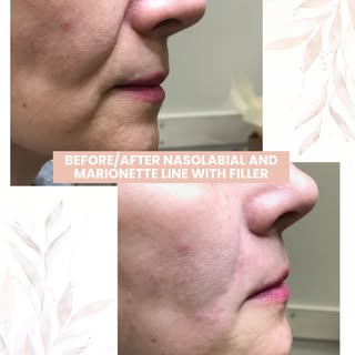 As we lose volume over time, the cheeks can flatten and the tissues around the nose and mouth can sh