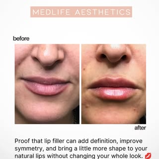 Lip filler doesn’t always mean bigger lips!! We say this all the time, but it's true💋

For some peo