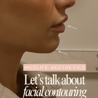 Facial contouring with filler can bring balance to different areas of the face, including the chin, 