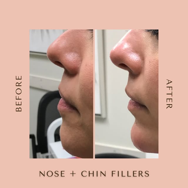 Small treatments = BIG results 🤩 

This patient reached out for #nosefiller and #chinfiller...two o