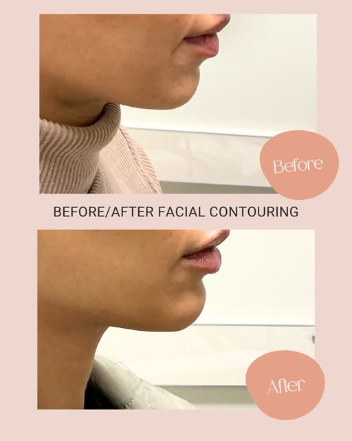 Facial contouring is all about enhancing your natural features and creating balance without making y