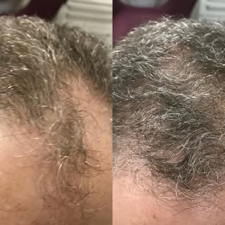 Tratamento integrativo para alopecia androgenética masculina 
.
O tratamento consiste em várias estr