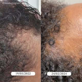 Tratamento para controle da alopecia padrão feminino. 🧬👩🏾
.
📲 Nos envie uma mensagem e agende su