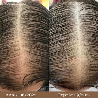 🌿Alopecia padrão feminino, muito comum entre as mulheres.

‼️Mais de 40% das mulheres sofrem com es