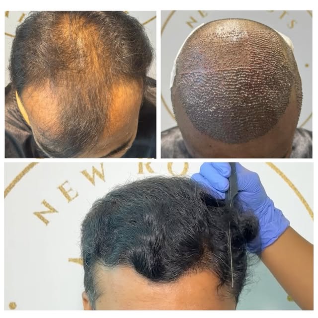 Grade 6 baldness. Natural hairline. Real transformation. ✨

From advanced baldness to a hairline tha
