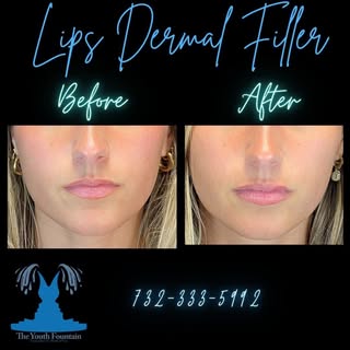 ✨ Unleash Your Inner Beauty with RHA Dermal Fillers! ✨ 

Before & After Alert! 👀 See the incredible