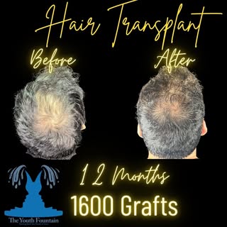 From balding to improved density! Check out this amazing hair transformation ➡️

Say goodbye to hair