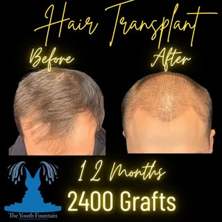 Check out this amazing hair transformation ➡️

Say goodbye to hair loss worries! 👋 This patient ach
