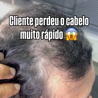 #protesecapilar #protesecapilarmasculina #mogimirim #campinas #mogiguaçu
