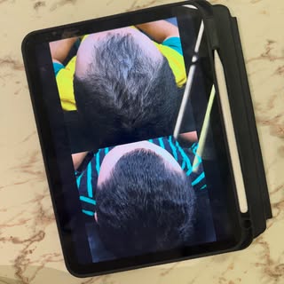 4 meses de tratamento e uma evolução que fala por si!

Sem Finasterida e Dutasterida oral, conseguim