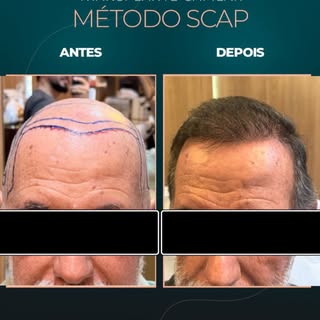 6 meses de transplante capilar 

Um resultado que mostra a evolução mês a mês: mais densidade, cober