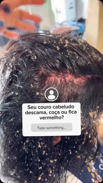Psoríase no couro cabeludo não é só “caspa”. ❌

Receitas caseiras e a troca constante de shampoo não