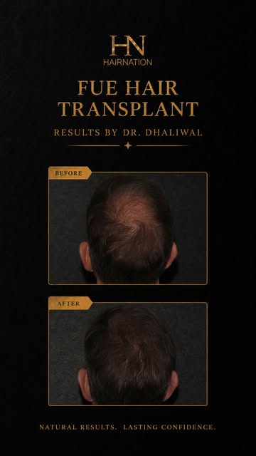 At 7 months post-FUE hair transplant, this patient is showing noticeable improvement in crown covera