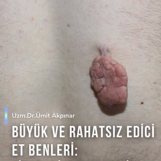 📌Her “et beni” küçük kalmaz.
Bazı fibroepitelyal polipler yıllar içinde büyüyerek hem kozmetik hem 