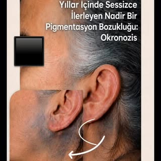 📌Yüz ve boyun bölgesinde giderek koyulaşan, gri-mavi veya kahverengimsi renk değişiklikleri her zam