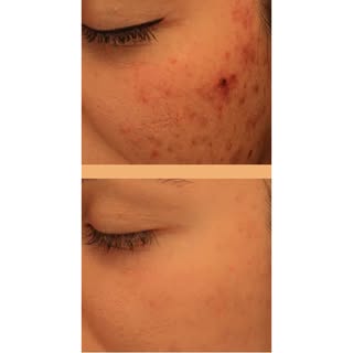 ✨ Clear Skin Starts Here ✨

Struggling with acne or dull, uneven skin? Our Vitamin C Peel by SkinCeu