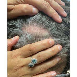 ✨ Hair Restoration Beyond Expectations ✨

Did you know hair growth is possible even in areas with su
