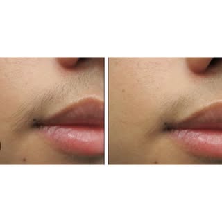 ✨ Smooth, confident skin starts here ✨

Say goodbye to unwanted upper lip hair with laser hair remov
