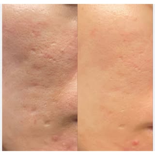 ✨ Microneedling + Hyaluronic Acid + Brightening Serum ✨

Our customized microneedling treatment comb